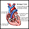 Tetralogy of Fallot