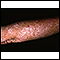 Queratosis actínica en el brazo