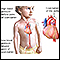 Coarctation of the aorta