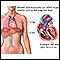 Cardiomiopatía dilatada