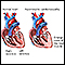 Cardiomiopatía hipertrófica