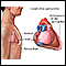 Pericarditis constrictiva