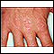 Dermatomyositis - Gottron's papules on the hand