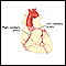 Coronary artery balloon angioplasty - series