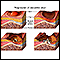 Progression of a decubitis ulcer