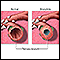 Bronchitis and Normal Condition in Tertiary Bronchus