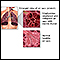 Enfermedad pulmonar obstructiva crónica (EPOC)