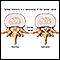 Spinal stenosis