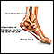 Plantar fasciitis