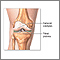 Knee joint replacement - series