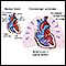 Eisenmenger syndrome (or complex)