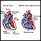 Doble salida ventricular derecha