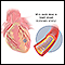 Coronary artery stent