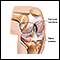 Knee joint replacement - Series