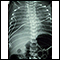 Totally anomalous pulmonary venous return - X-ray