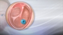 Ear tube insertion