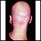 Alopecia totalis - visão posterior da cabeça