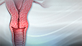 Cervical cancer