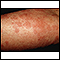 Ronchas (urticaria) en el brazo