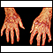 Lichen planus on the hands