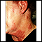 Herpes zoster (shingles) on the neck and cheek