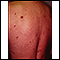 Kaposi sarcoma on the back