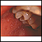 Measles, Koplik spots - close-up