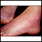 Erythema nodosum on the foot