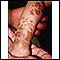 Incontinentia pigmenti on the leg