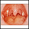 Mononucleose - visualização da garganta