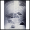 Radiografía de obstrucción del intestino delgado