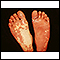 Sturge-Weber syndrome - soles of feet