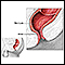 Cirurgia de hemorroidas - série