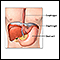 Hiatal hernia repair - series