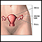 Hysterectomy - series