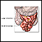 Small bowel resection - series