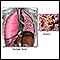 Normal lungs and alveoli