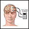 Brain wave monitor