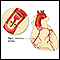 Coronary artery disease