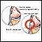 Dolor del ligamento colateral externo