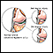 Lesión del ligamento colateral lateral