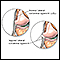 Ligamento colateral lateral desgarrado