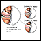 Lesión del ligamento medial colateral