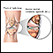 Ligamento medial colateral