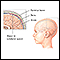 Pressão intracraniana aumentada