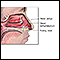 Nasal polyps